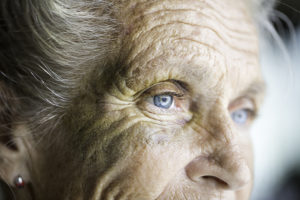 Senior woman with bruised skin